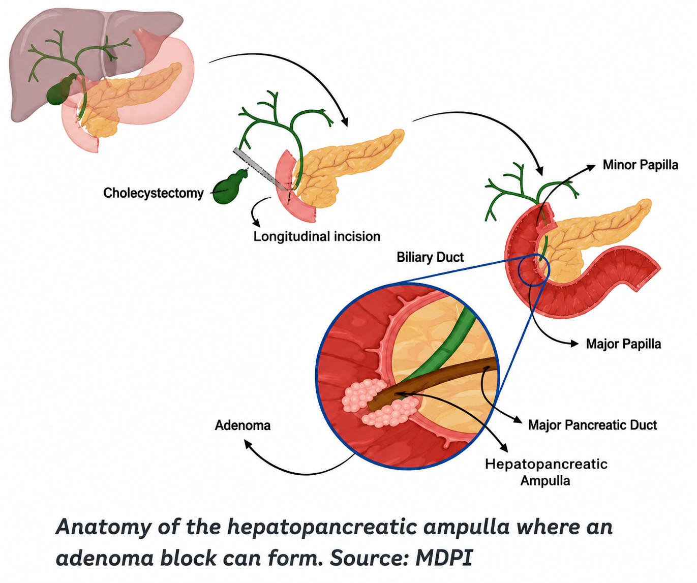 Endoscopic ampullectomy case study blog article