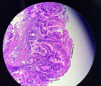 Histopathology confirming ampullary adenoma with clear margins