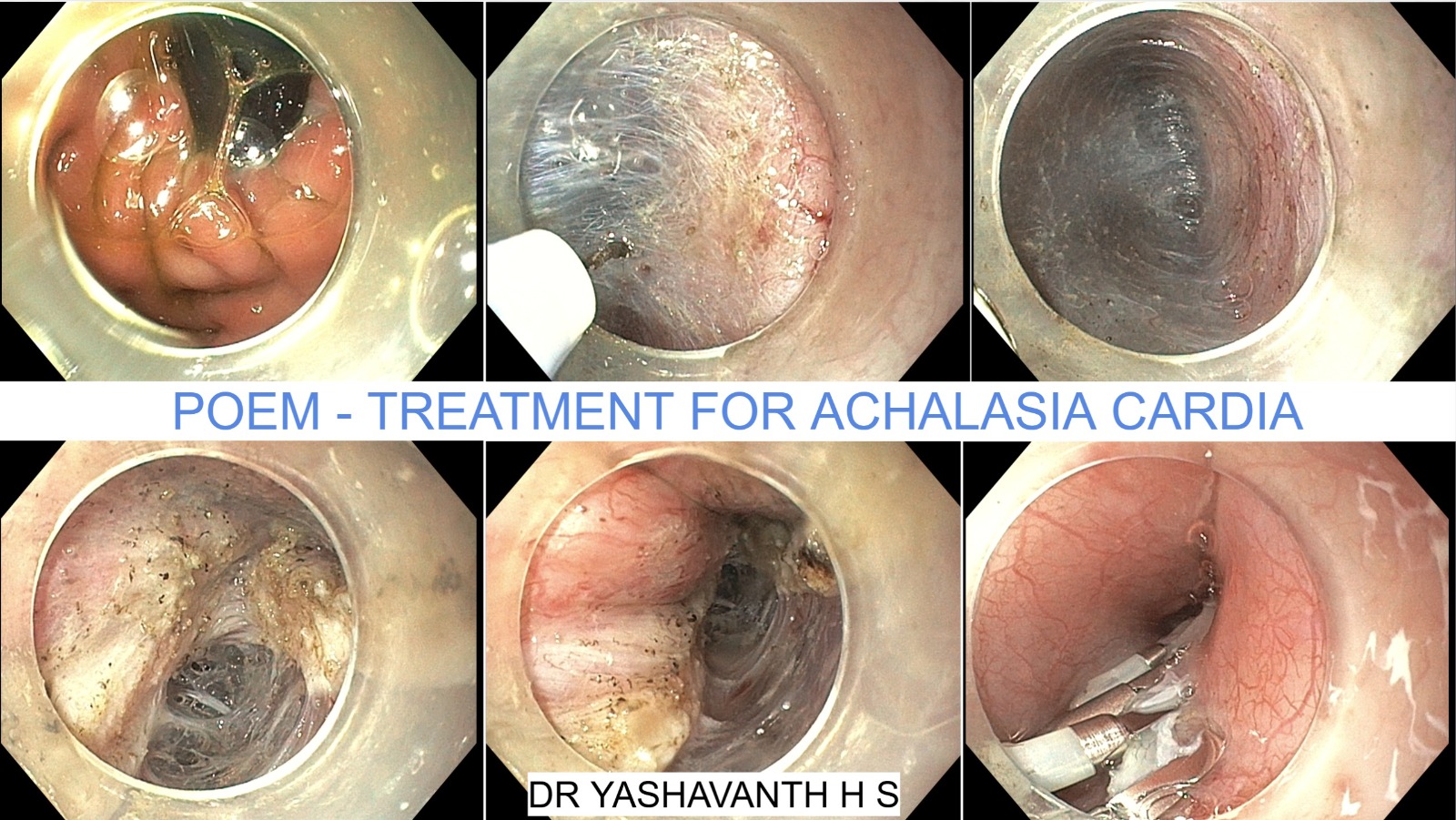 Illustration for POEM procedure achalasia treatment blog article