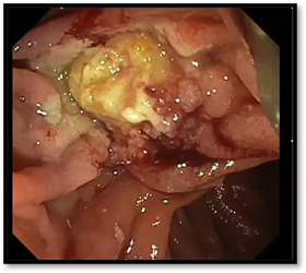 Endoscopic view before and after ampullectomy