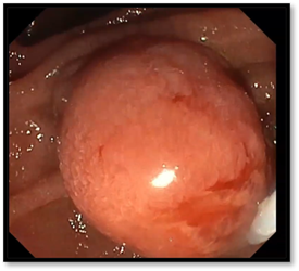 Endoscopic ultrasound used for precision staging of ampullary lesion